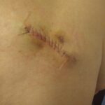Stitches of nearly 4 inches from basal cell cancer removal surgery.